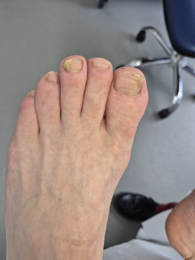 After nail treatment 2025