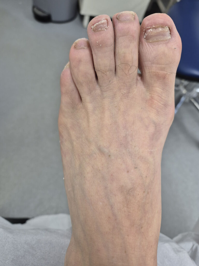 Before nail treatment 2025