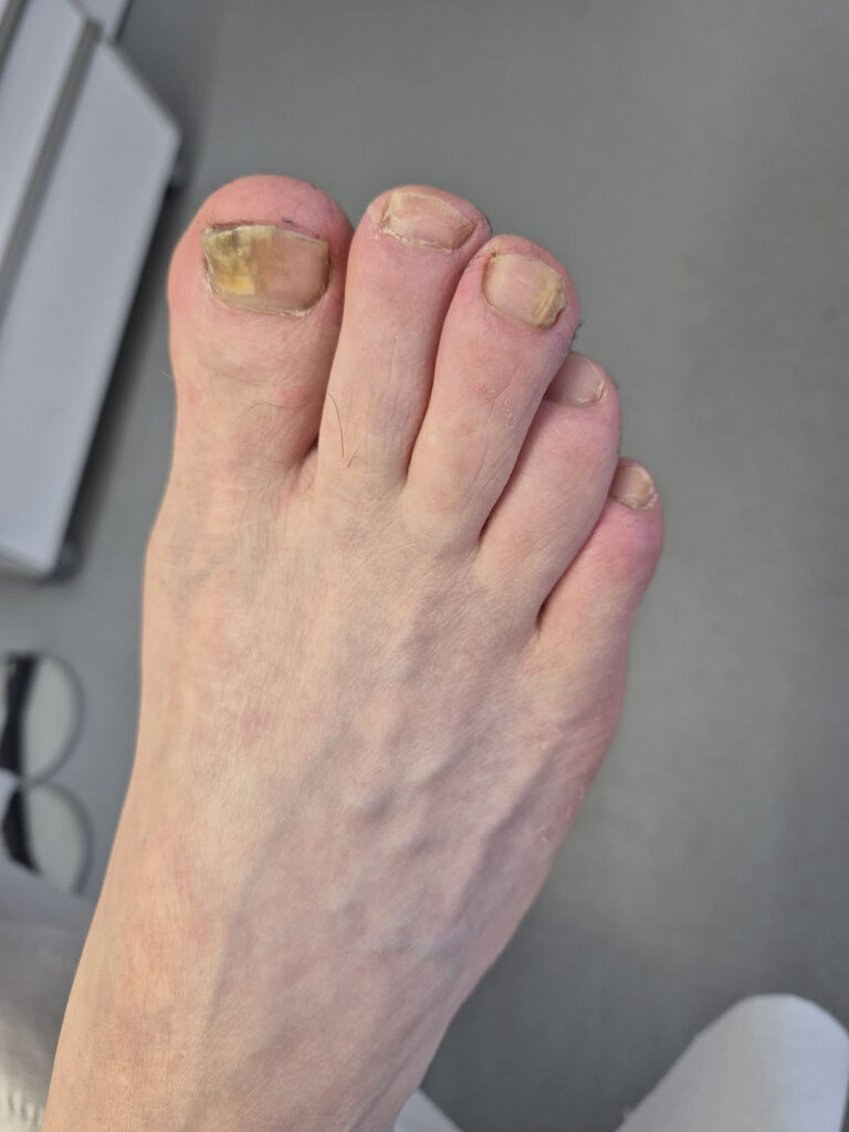 After nail treatment 2025