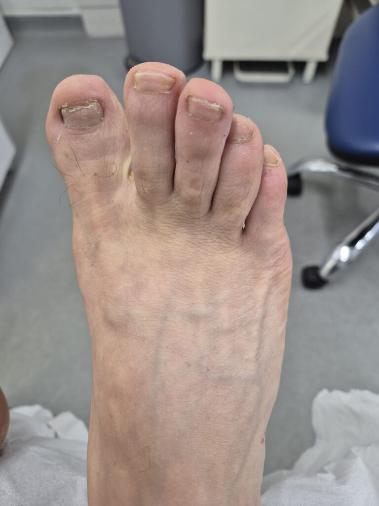 Before nail treatment 2025