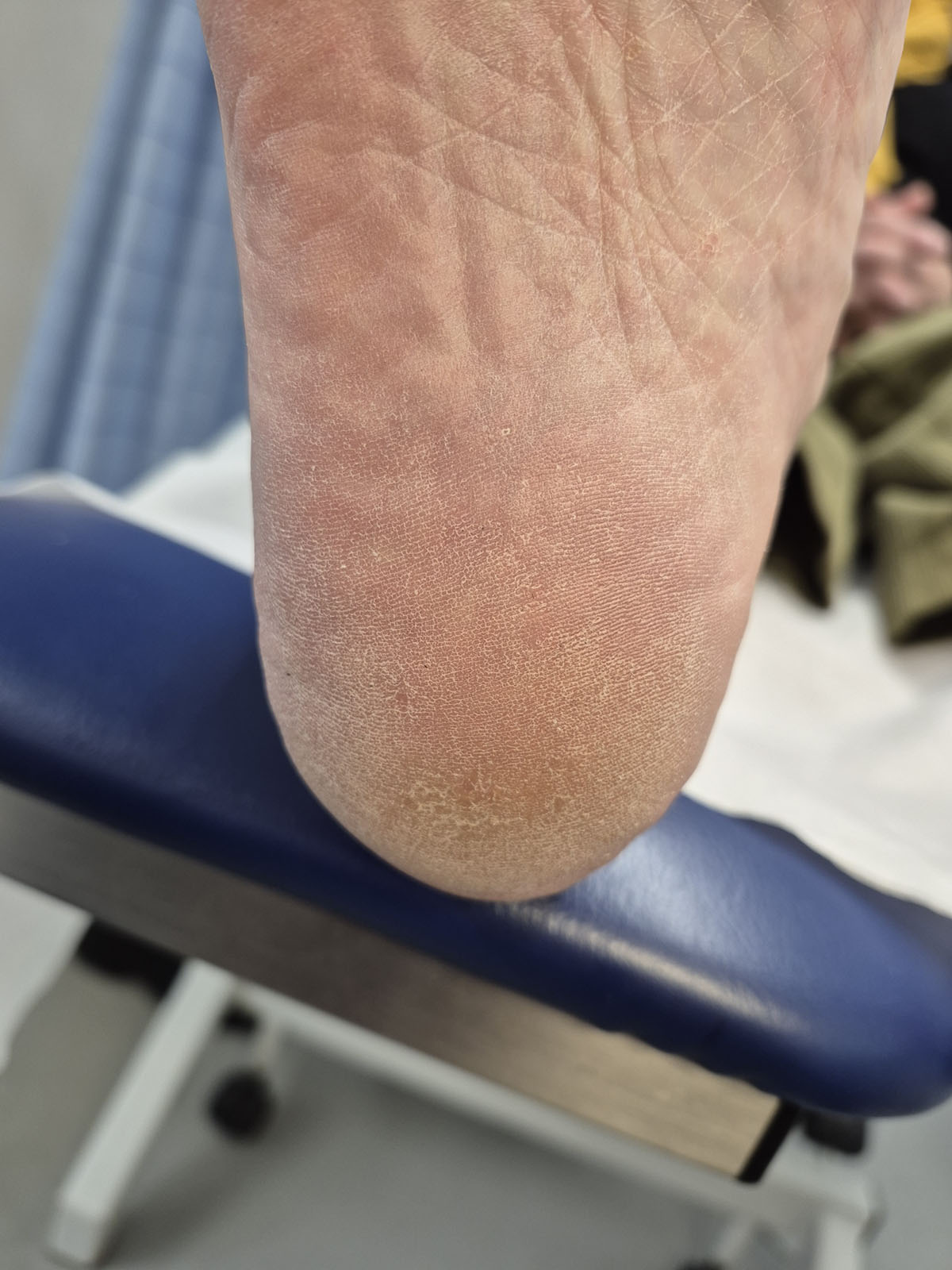 After verruca treatment