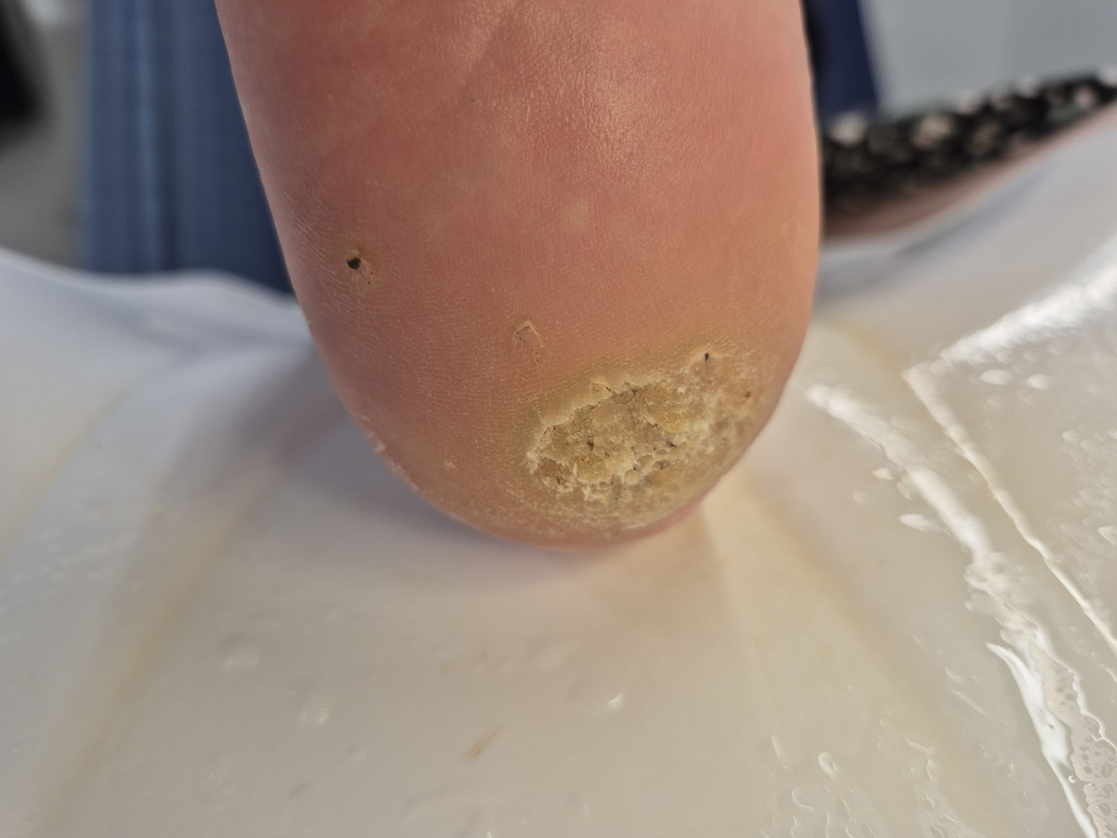 Before verruca treatment