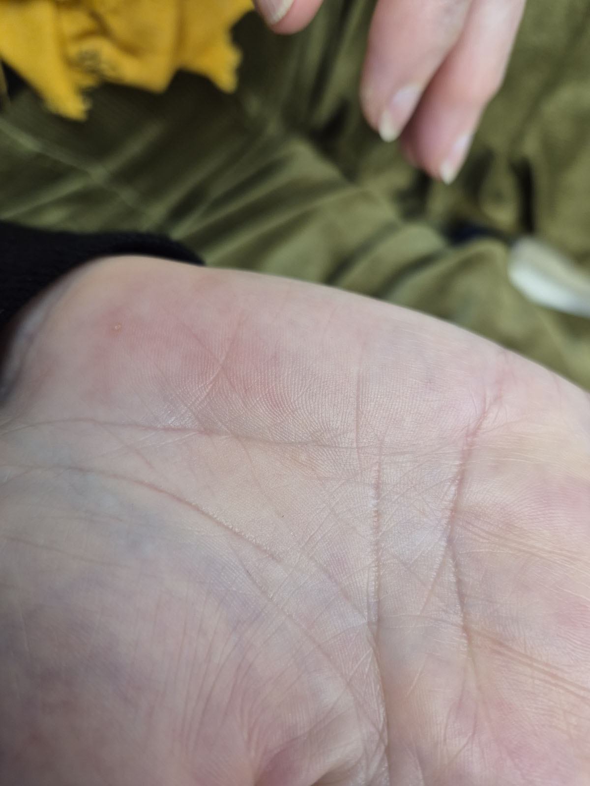 After wart treatment