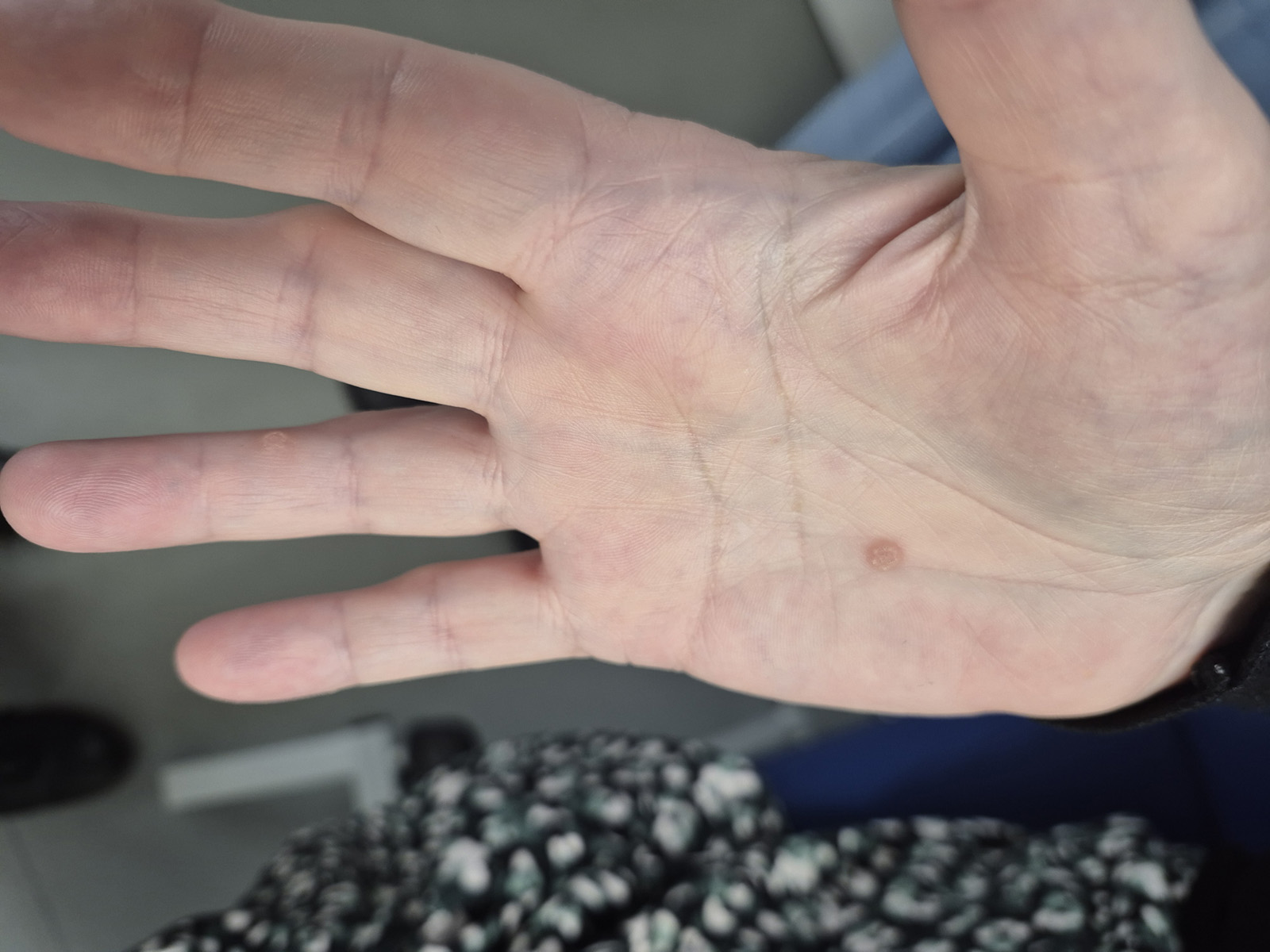 Before wart treatment